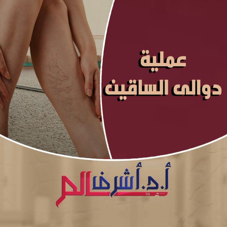 دوالى الساقين