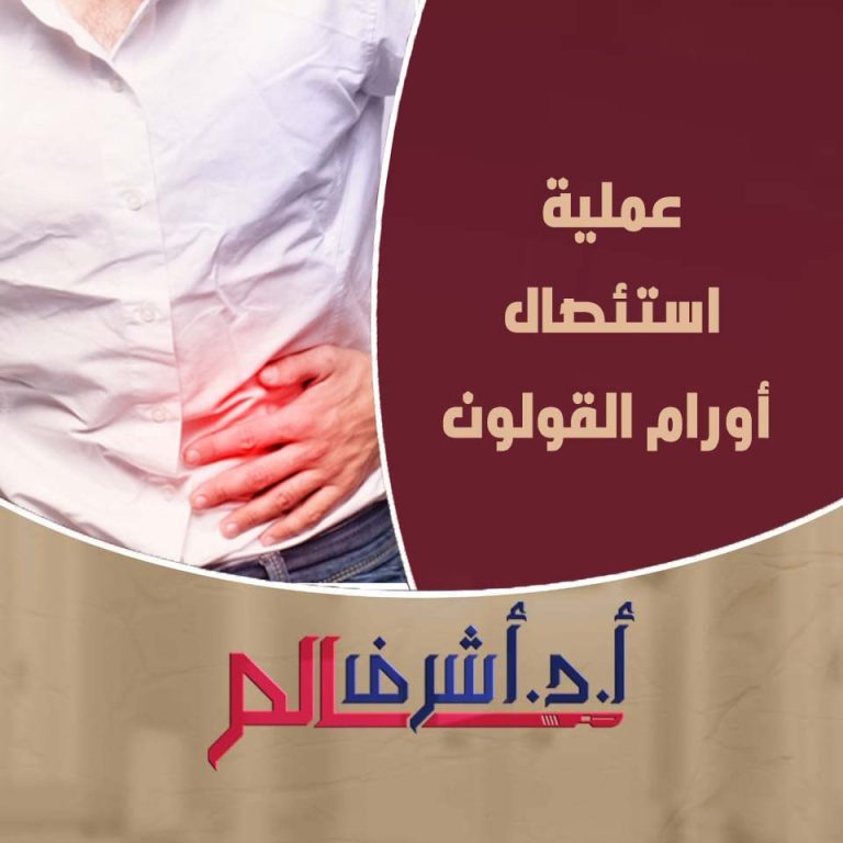  استئصال أورام القولون