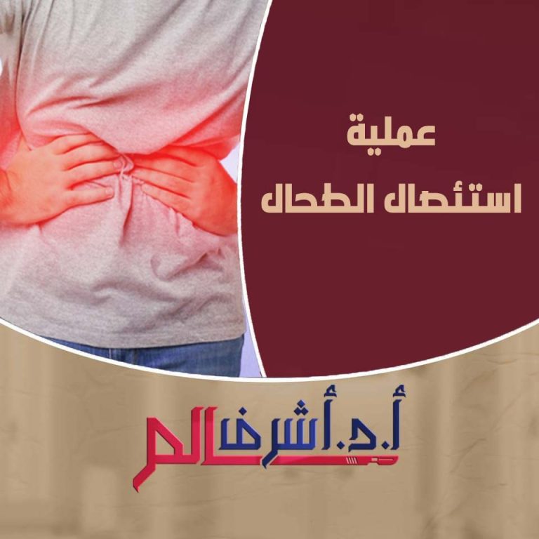 استئصال الطحال