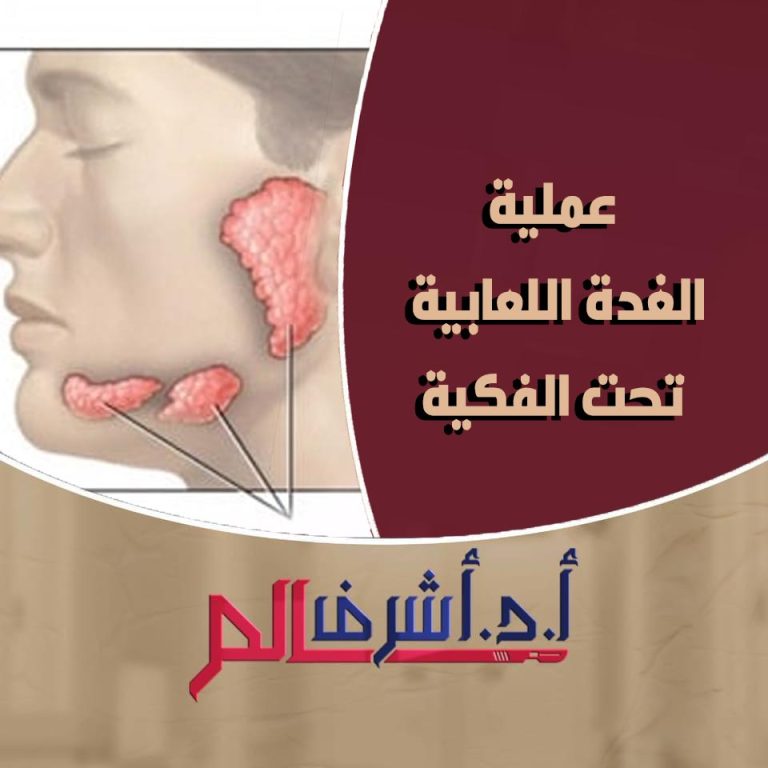 استئصال الغدة اللعابية تحت الفكية