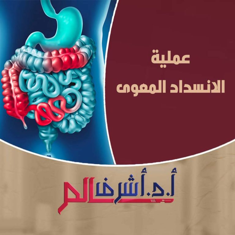  الانسداد المعوي