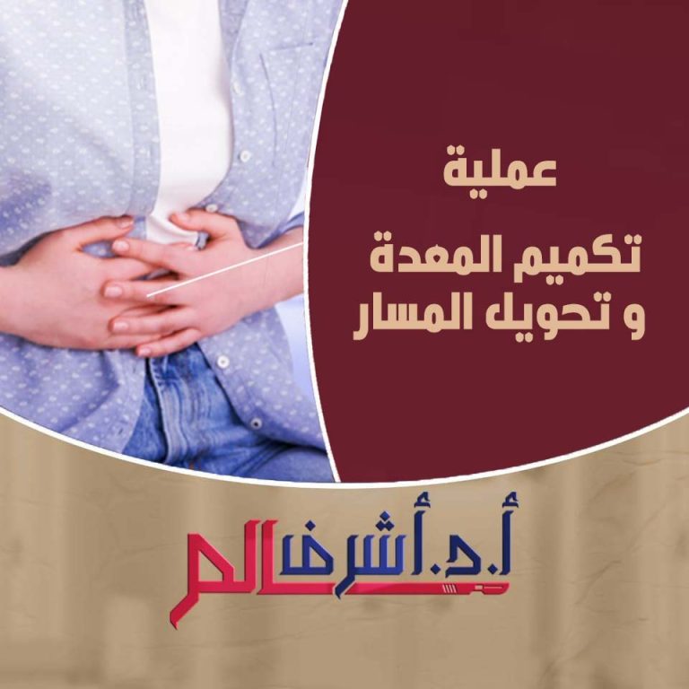 عملية تكميم المعدة وتحويل المسار