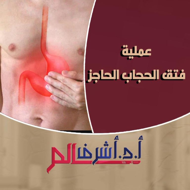 علاج فتق الحجاب الحاجز