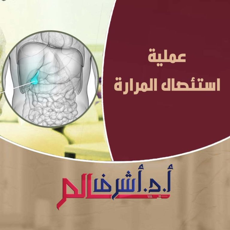 استئصال المرارة