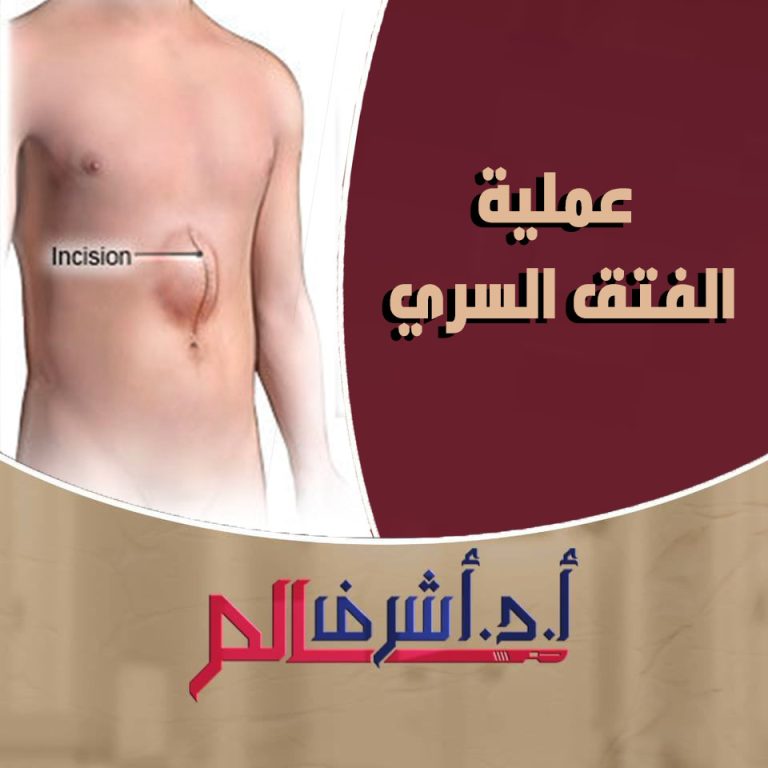 الفتق السري: الأسباب، الأعراض والعلاج