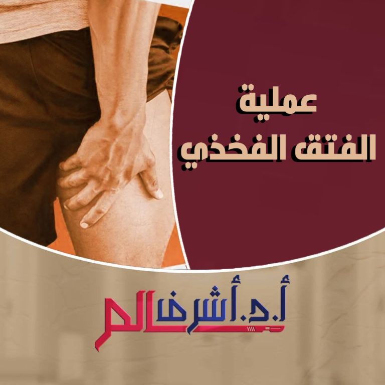 الفتق الفخذي: الأسباب، الأعراض والعلاج